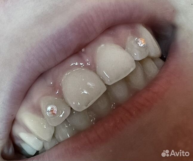 Установка скайсов