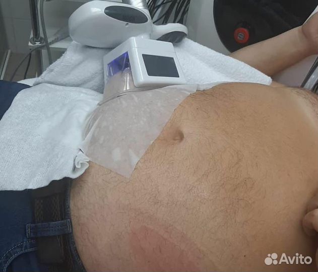 Криолиполиз,кавитация,карбоновый пилинг,эндо360