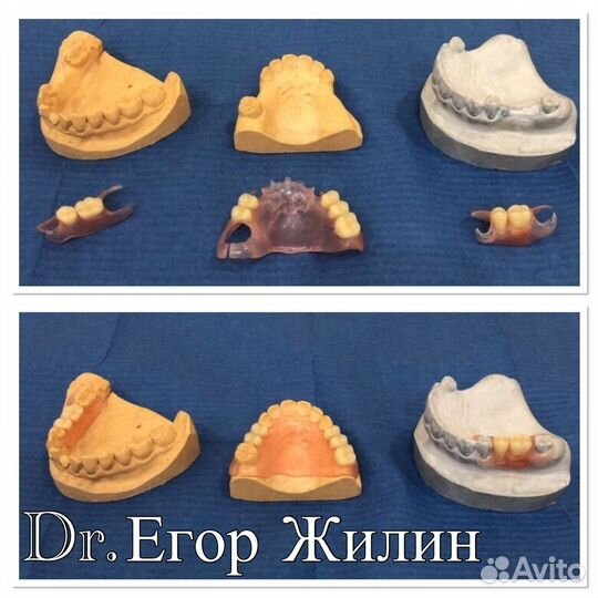 Гибкие протезы