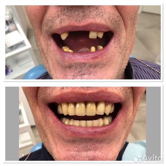 Гибкие протезы