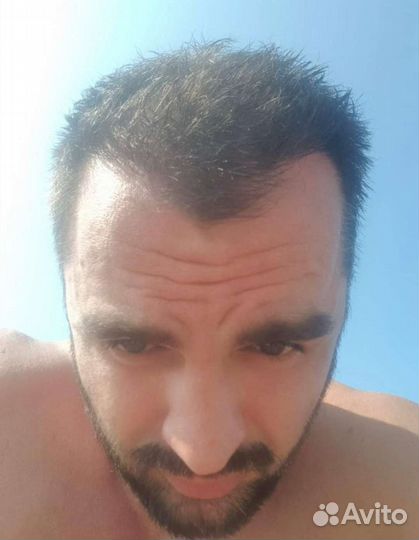 Пересадка волос без швов, рубцов и шрамов