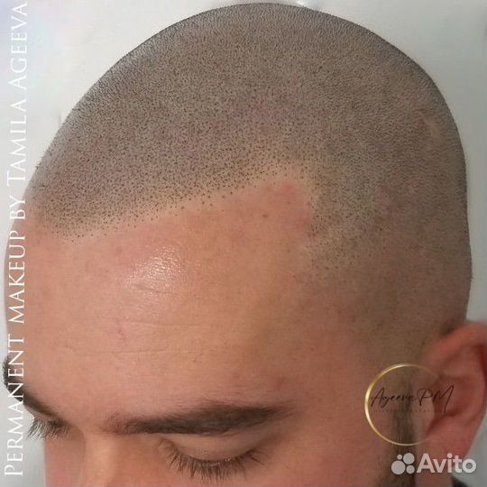 Трихопигментация, камуфляж шрамов и ожогов