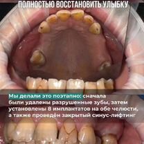 Протезирование зубов в рассрочку, Москва