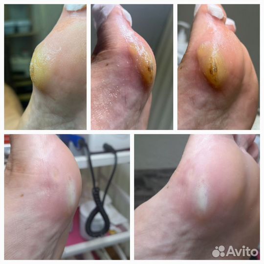 Коррекция вросшего ногтя