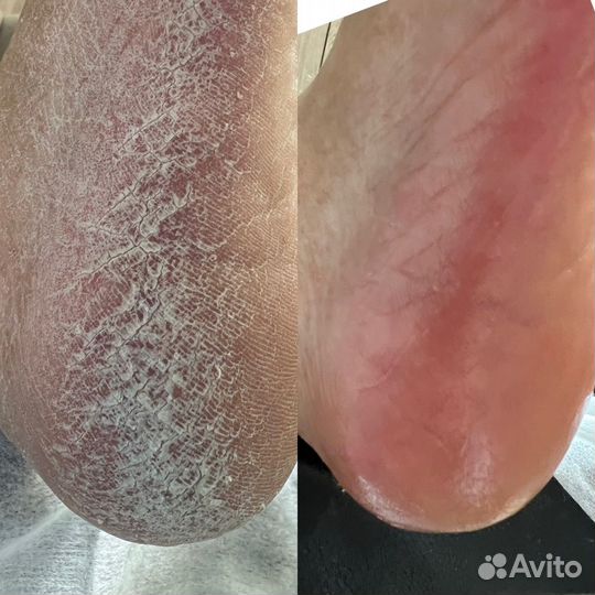 Подолог, педикюр медицинский, вросший ноготь