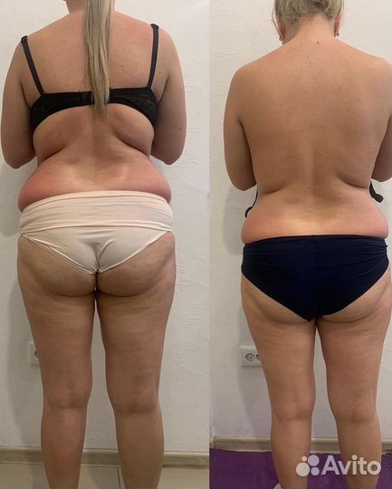 Аппаратная коррекция фигуры