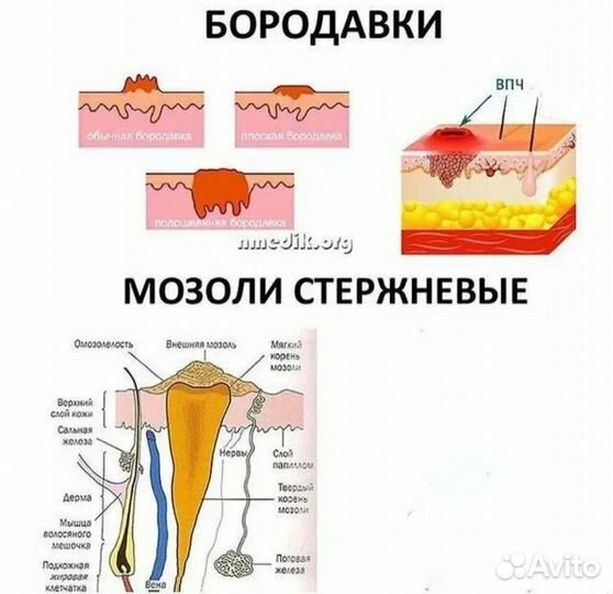 Удаление стержневых подошвенных мозолей