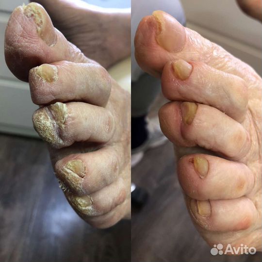 Услуги подолога с выездом на дом