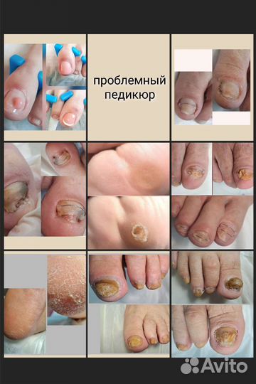 Установка титановой нити, установка тампонады