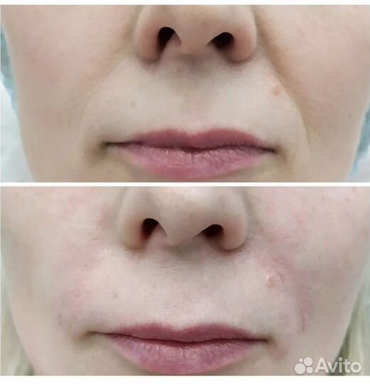 Услуги косметолога уколы красоты