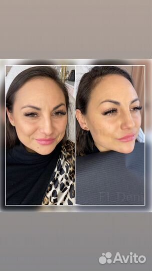 Губы, Ботокс. Full Face Требуются модели