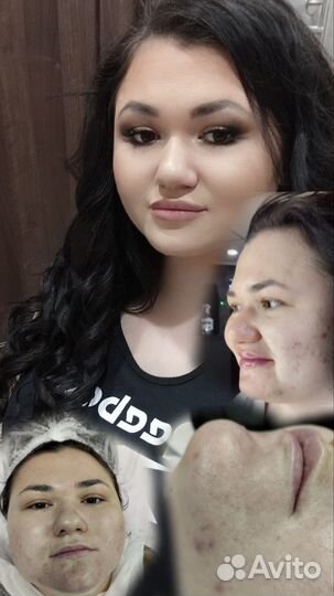 Увеличение губ