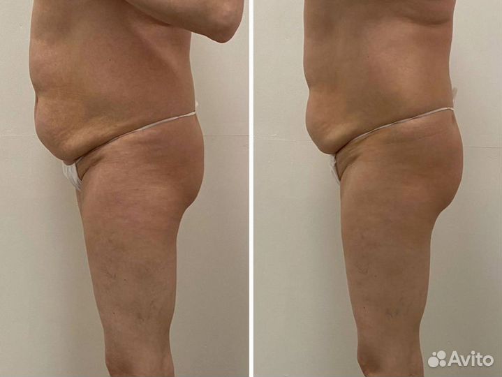 Антицеллюлитный массаж, коррекция фигуры