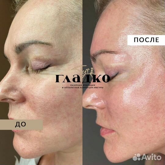 Карбоновый пилинг