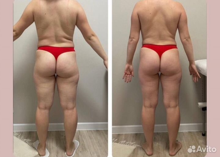 LPG массаж тела