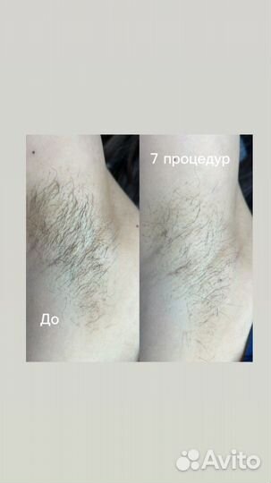 Электроэпиляция