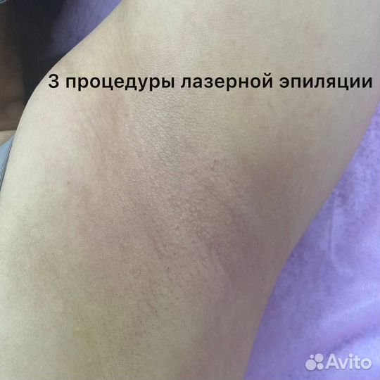 Лазерная эпиляция 7-ми зон по цене 2-х
