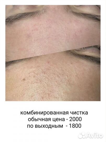 Ультразвуковая чистка лица