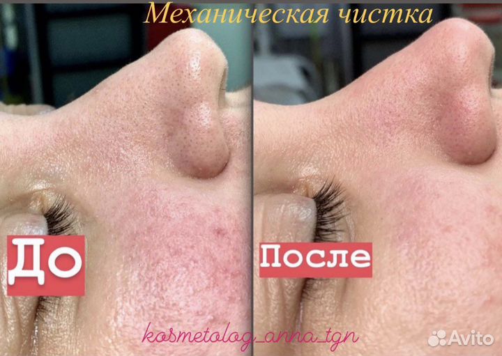 Чистки, пилинги, уходовые процедуры, массаж лица