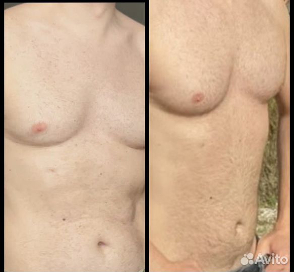 Лазерная эпиляция диодный лазер