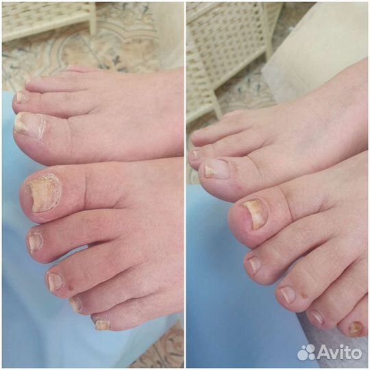 SMART - педикюр