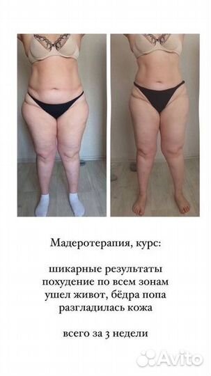 Коррекция фигуры безболезненно