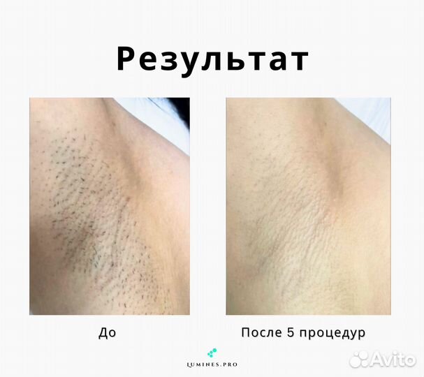 Диодный лазер Lumines-M MaxOne 1200 Вт