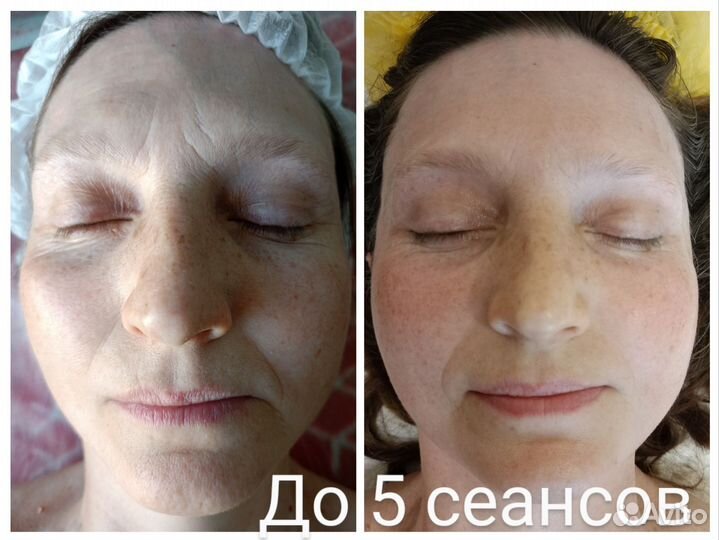 Массаж лица, безоперационное омоложение