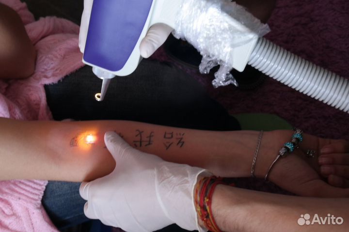Лазерное удаление татуировок и татуажа