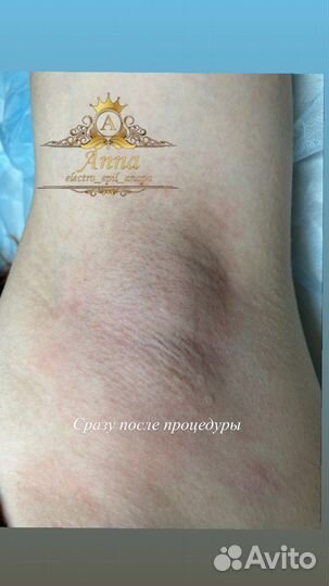 Электроэпиляция/шугаринг