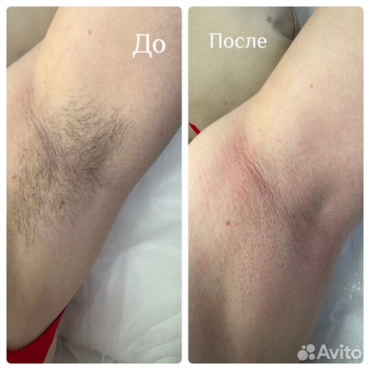 Шугаринг депиляция