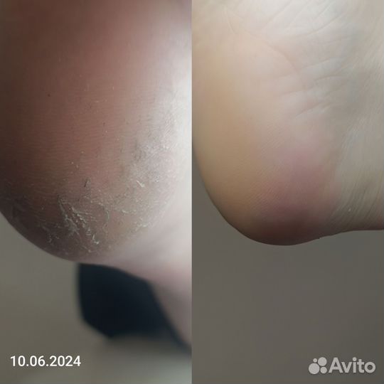 Педикюр kane PAP, парамедицинский, подология