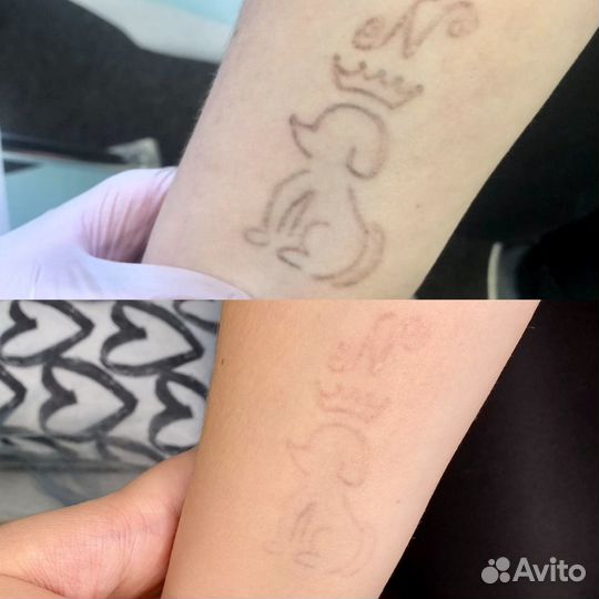 Удаление тату/татуажа