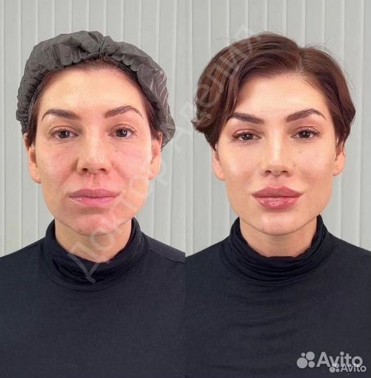 Подтяжка лица за одну процедуру. Альтератерапия