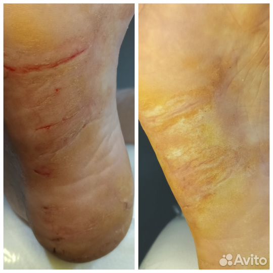 Педикюр, подолог