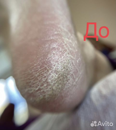 Инновационный Smart-педикюр