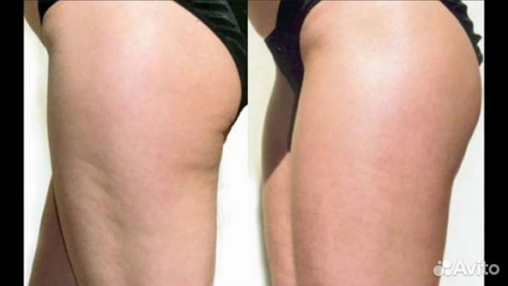 Вибрационный массаж от целлюлита G5