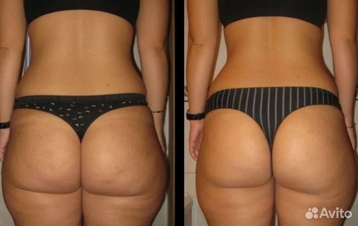 LPG идеальное тело- легко