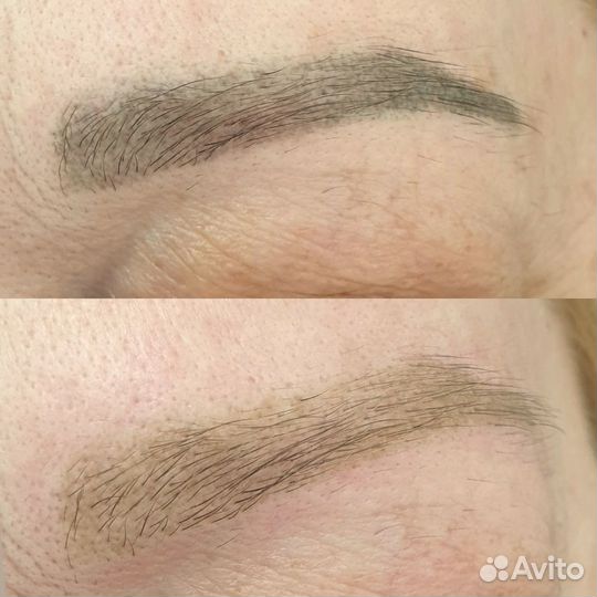 Удаление татуажа