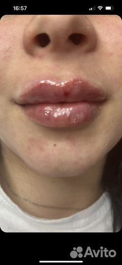 Увеличение Губ