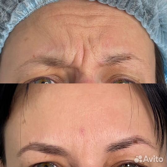 Ботокс для лица