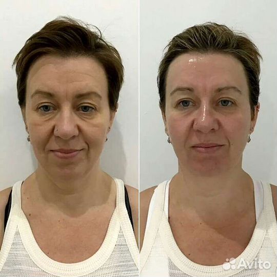 Смас лифтинг