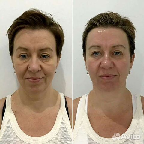 Смас лифтинг