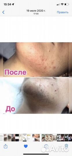 Эпиляция