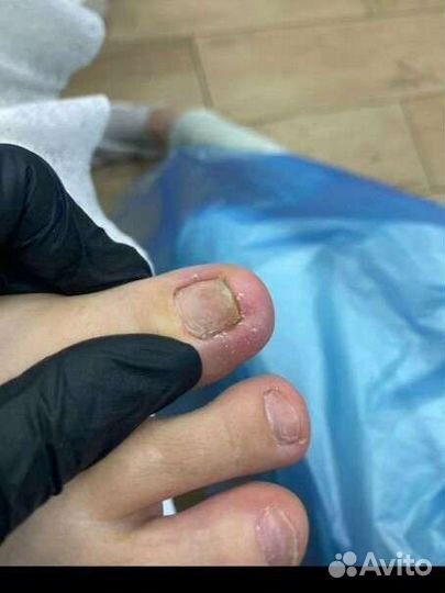 Установка титановой нити, вросший ноготь