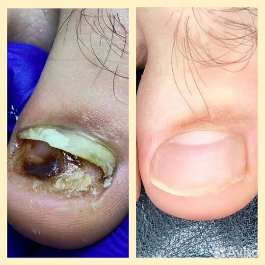 Педикюр подолог