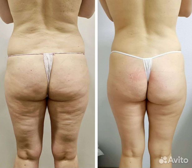 Классика/антицеллюлитный