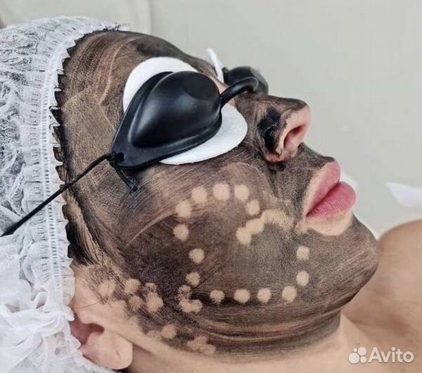 Карбоновый пилинг