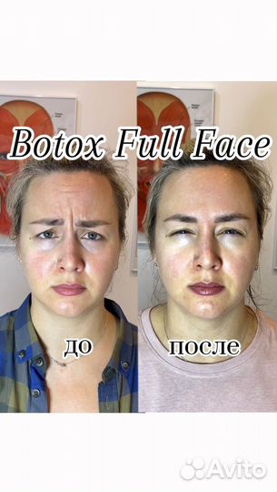 Ботокс Full Face