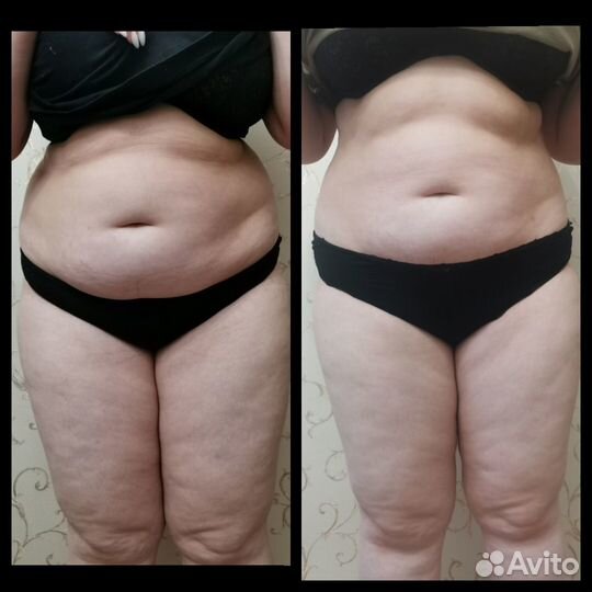 Антицеллюлитный массаж выезд на дом